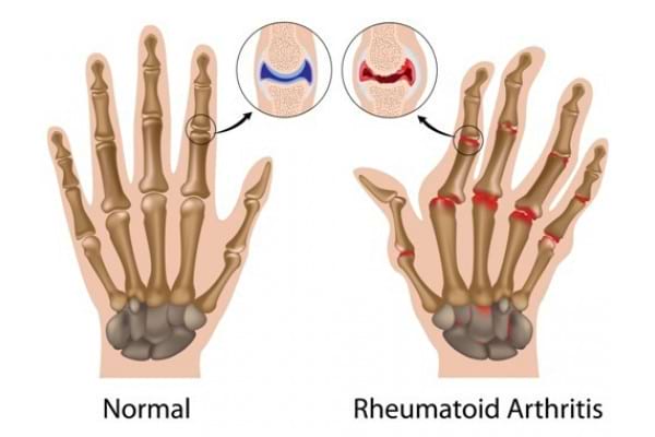 artrita reumatoidă a articulațiilor mari)